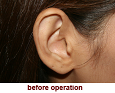 plastic-surgery-prominent-ear 